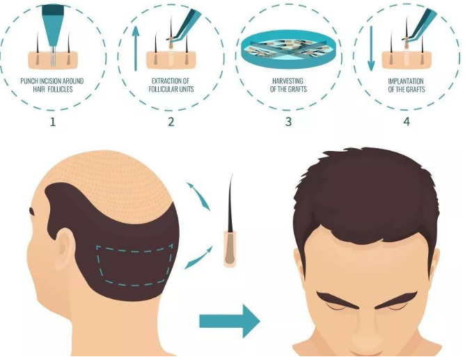 杭州植发医院排名(杭州植发医院排名前三的)-第3张图片